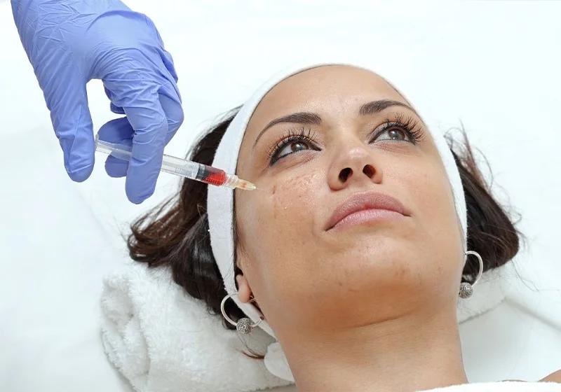 Cheekbone Filler dr fevzi kunter erten