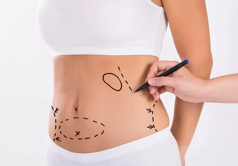 Tummy Tuck dr fevzi kunter erten